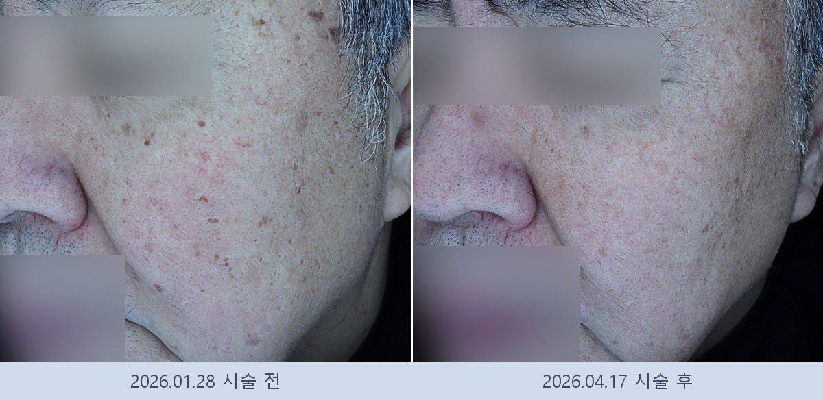 흑자 검버섯